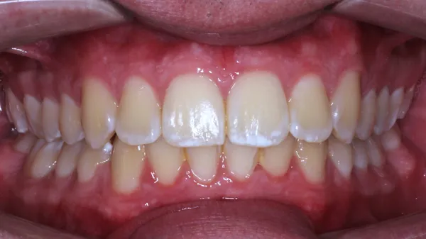 Caso 01 brackets · después